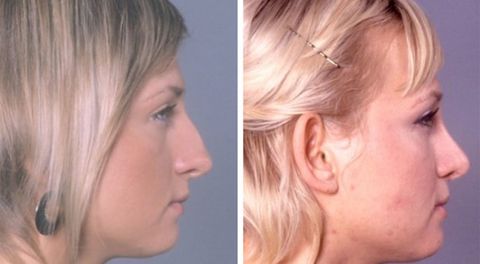 Before and after Rhinoplasty 5