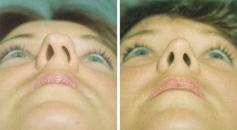 Before and after Rhinoplasty 8