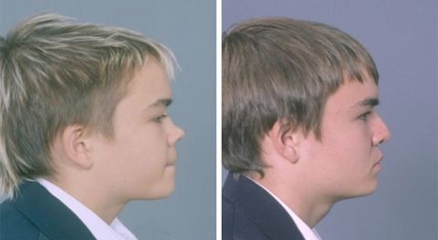 Before and after Rhinoplasty 8