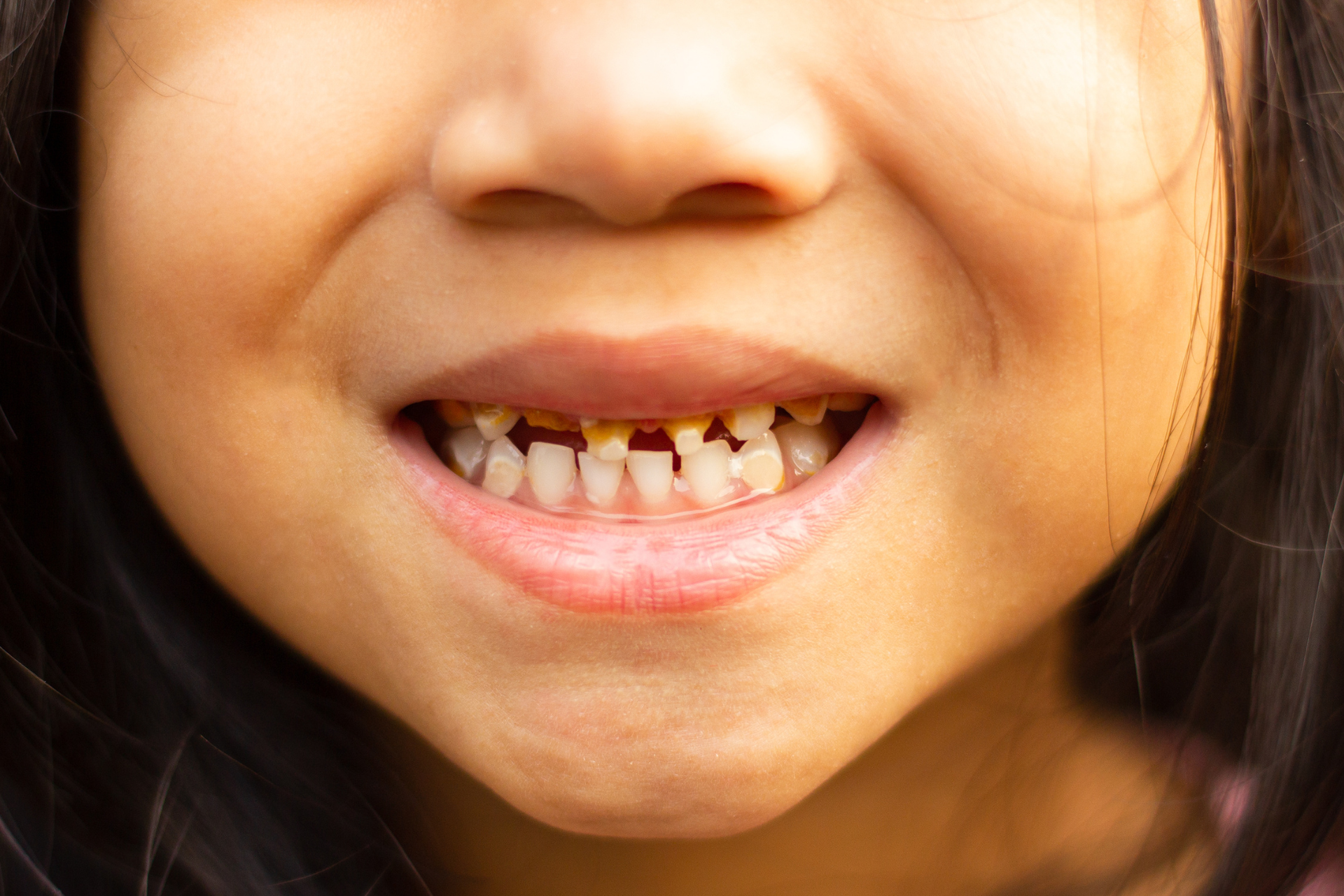 a close up of a child 's mouth with a tooth missing