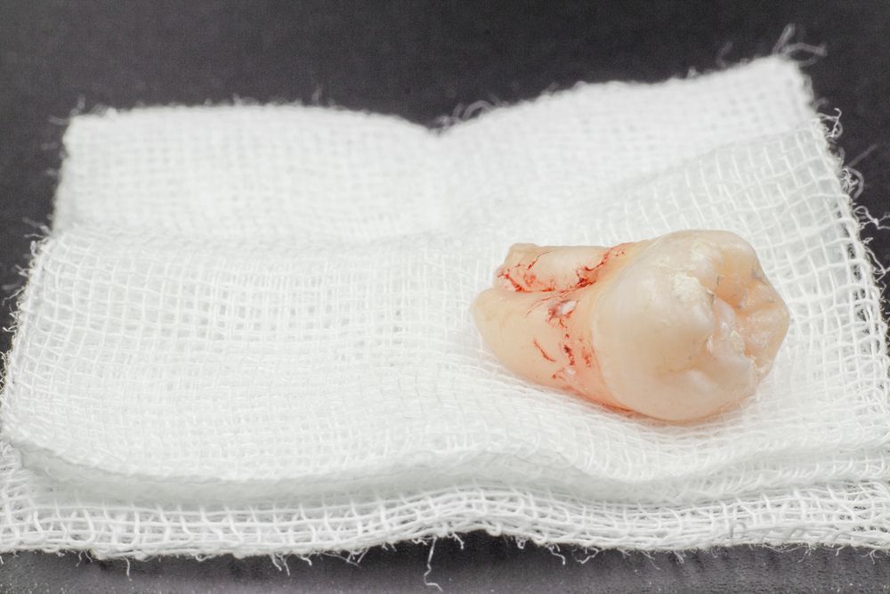 Tooth on a Gauze after extraction