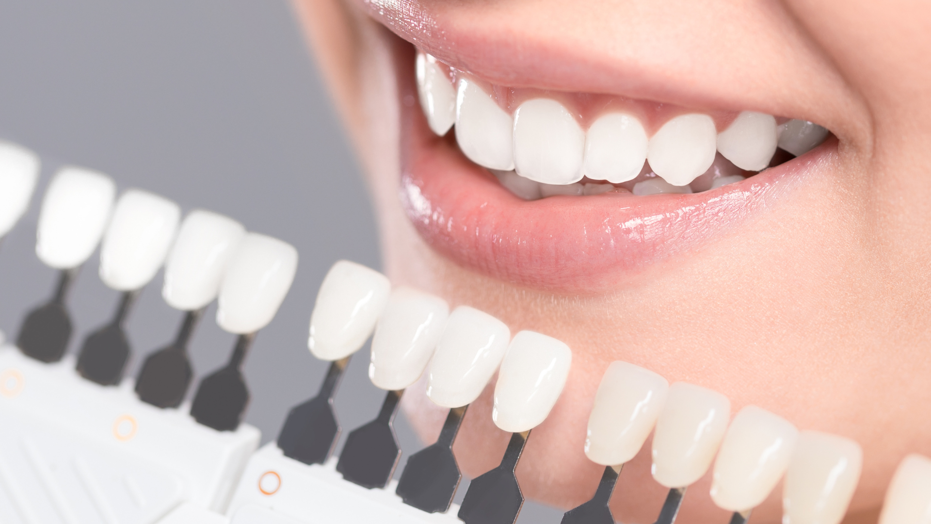 A close up of a woman 's teeth with a tooth color chart.