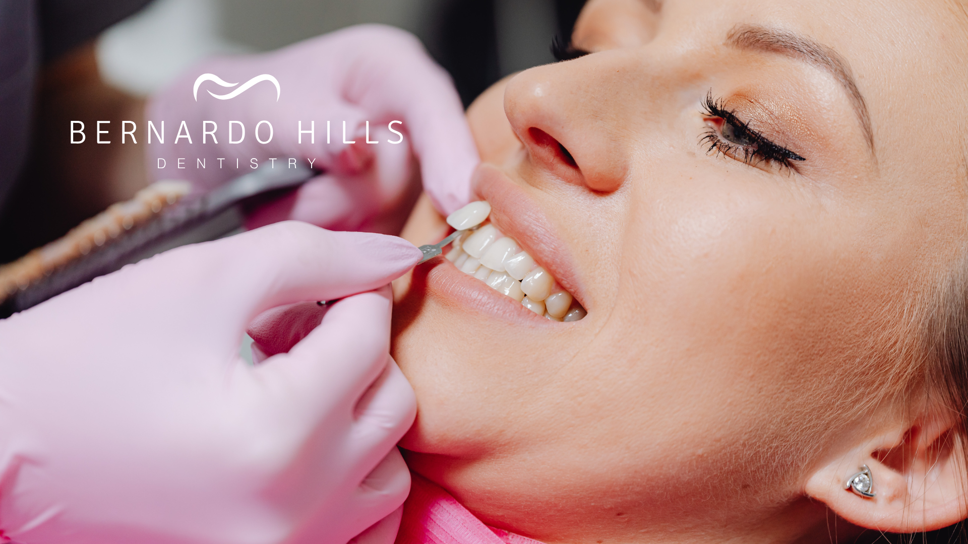 Your Holiday Smile Makeover: How Long Does It Take to Get Veneers?
