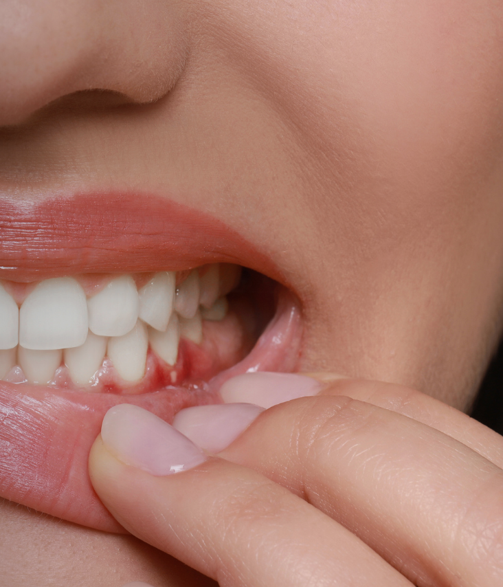 A before and after photo of a woman 's teeth.