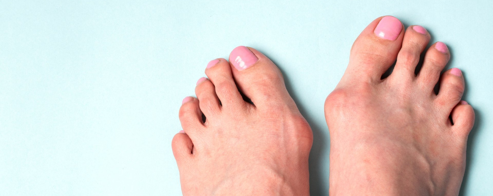 Common treatments for bunions Baton Rouge