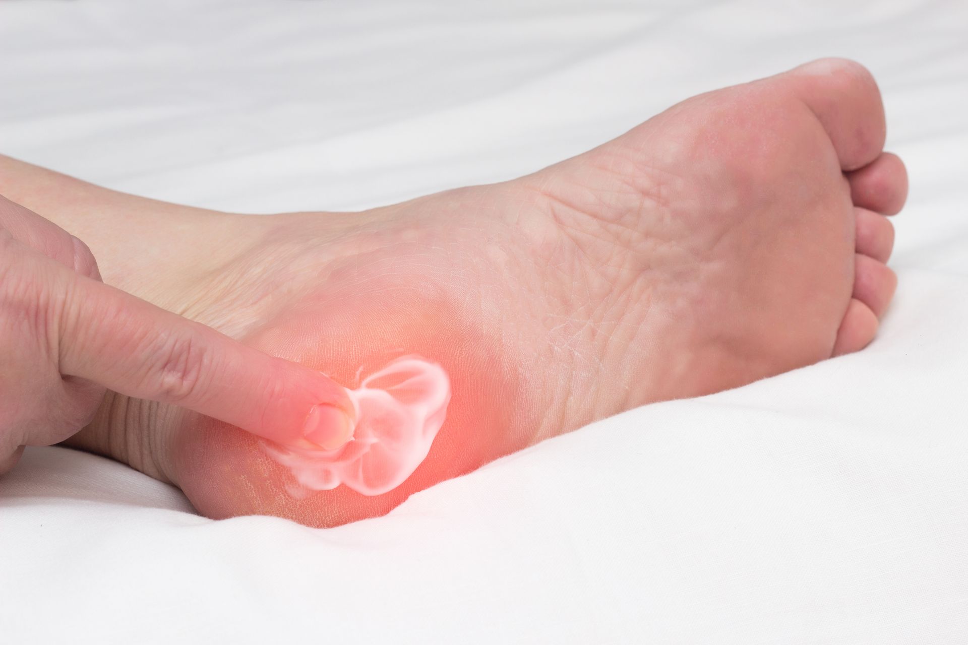 Plantar Fasciitis and Inflammation: What Role Does Diet Play? 