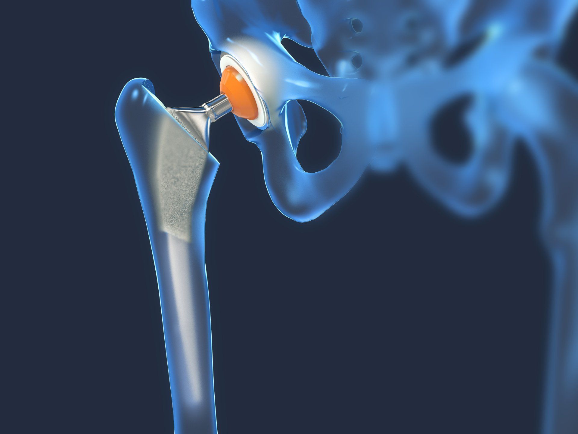 SuperPath vs. Anterior Hip Replacement: Which is Better?
