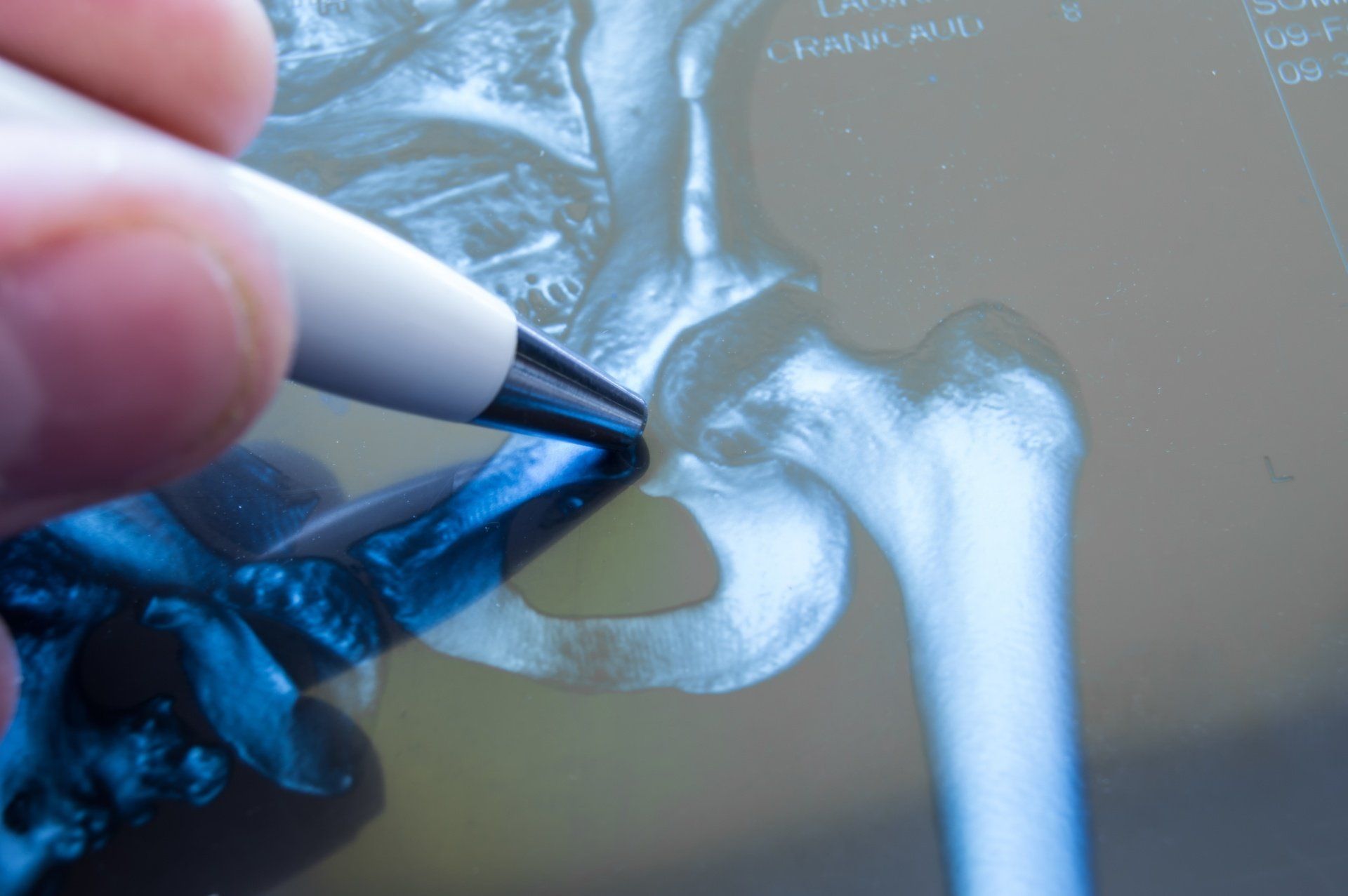 PAO and Hip Dysplasia: The Procedure and Benefits