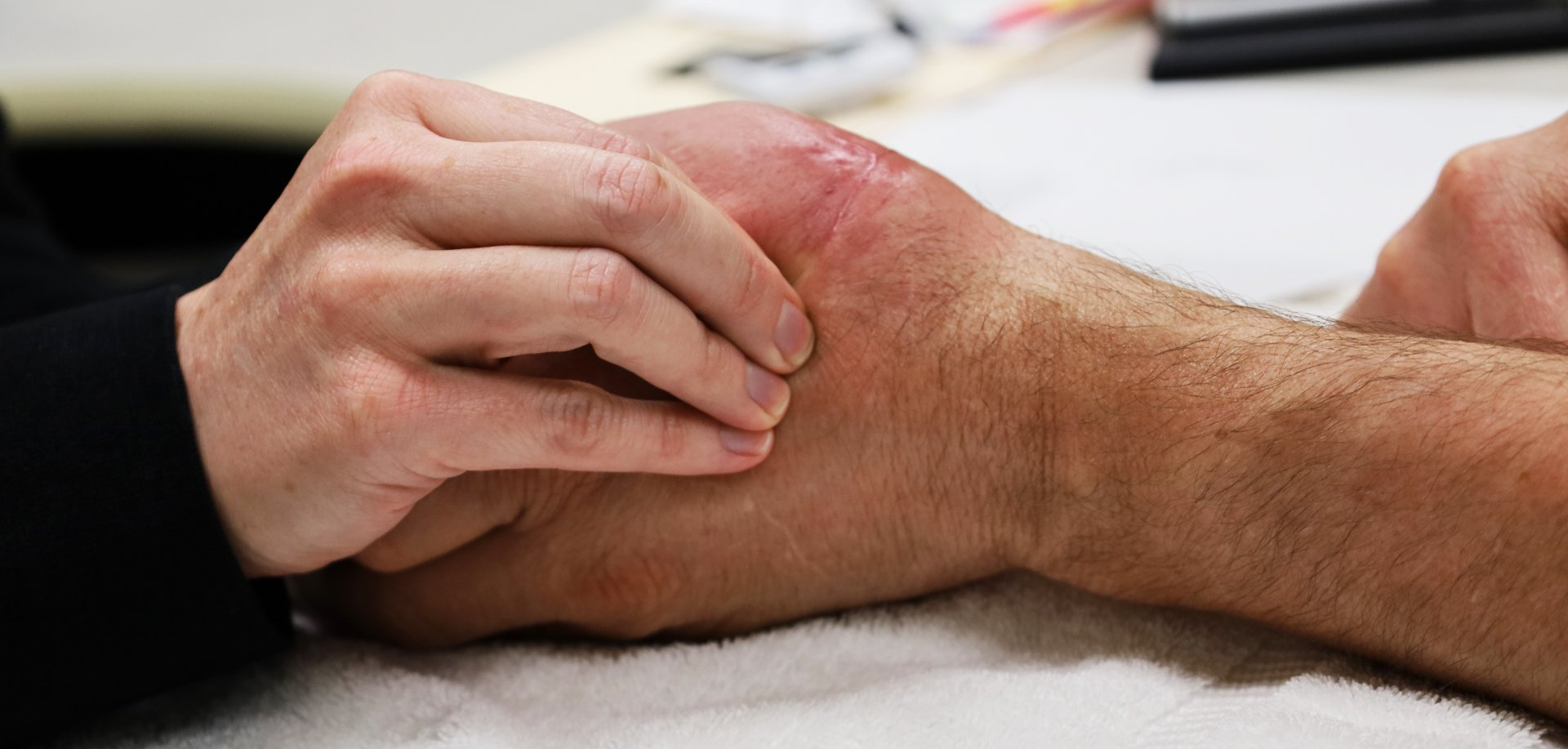 will hand injury or condition require physical therapy?