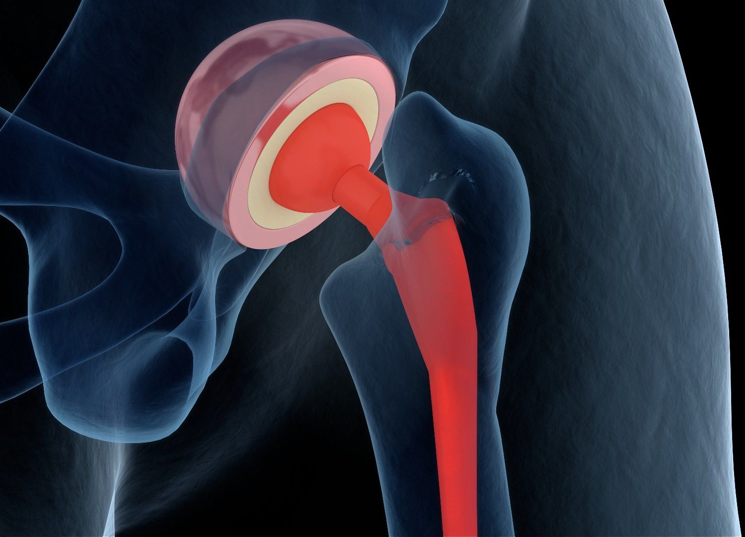 SuperPath Hip Replacement The Major Benefits