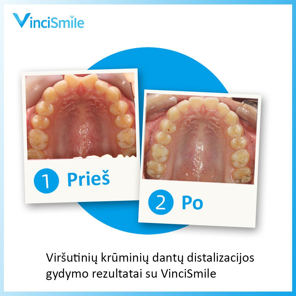 VinciSmile prieš ir po