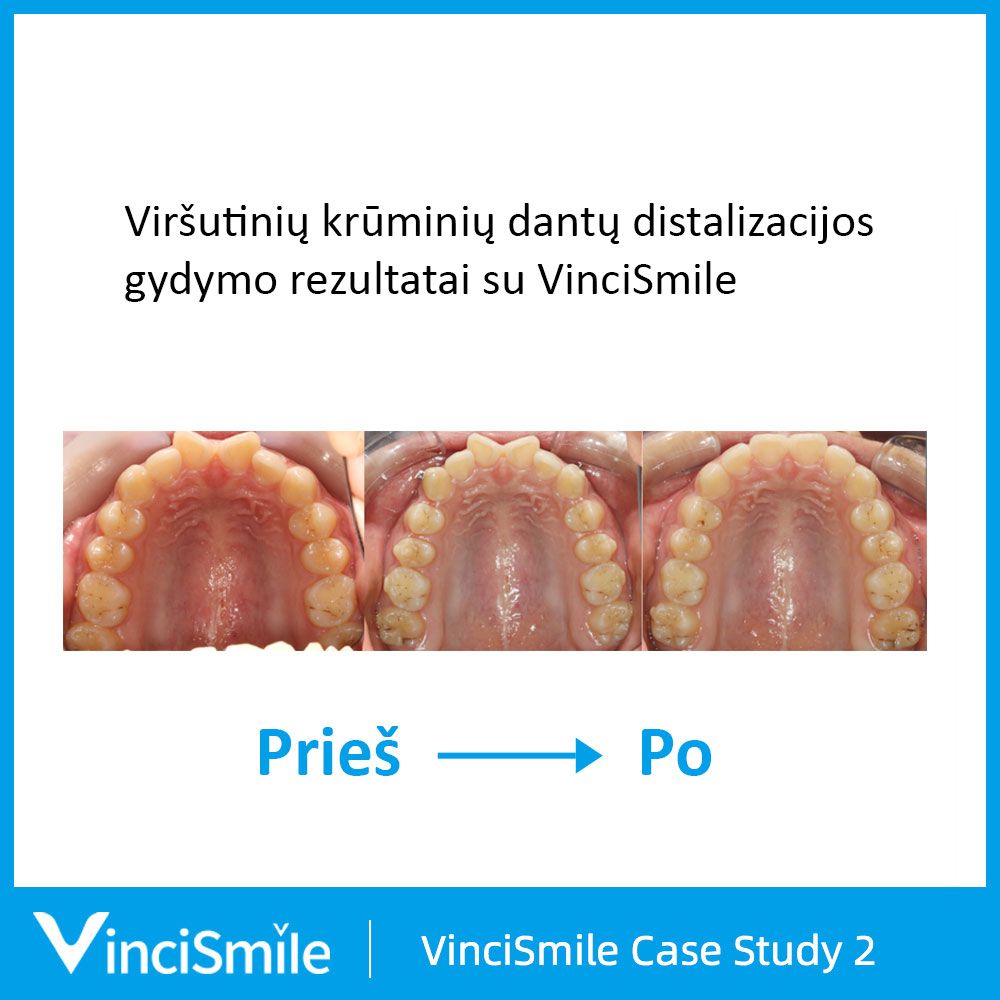 VinciSmile prieš ir po