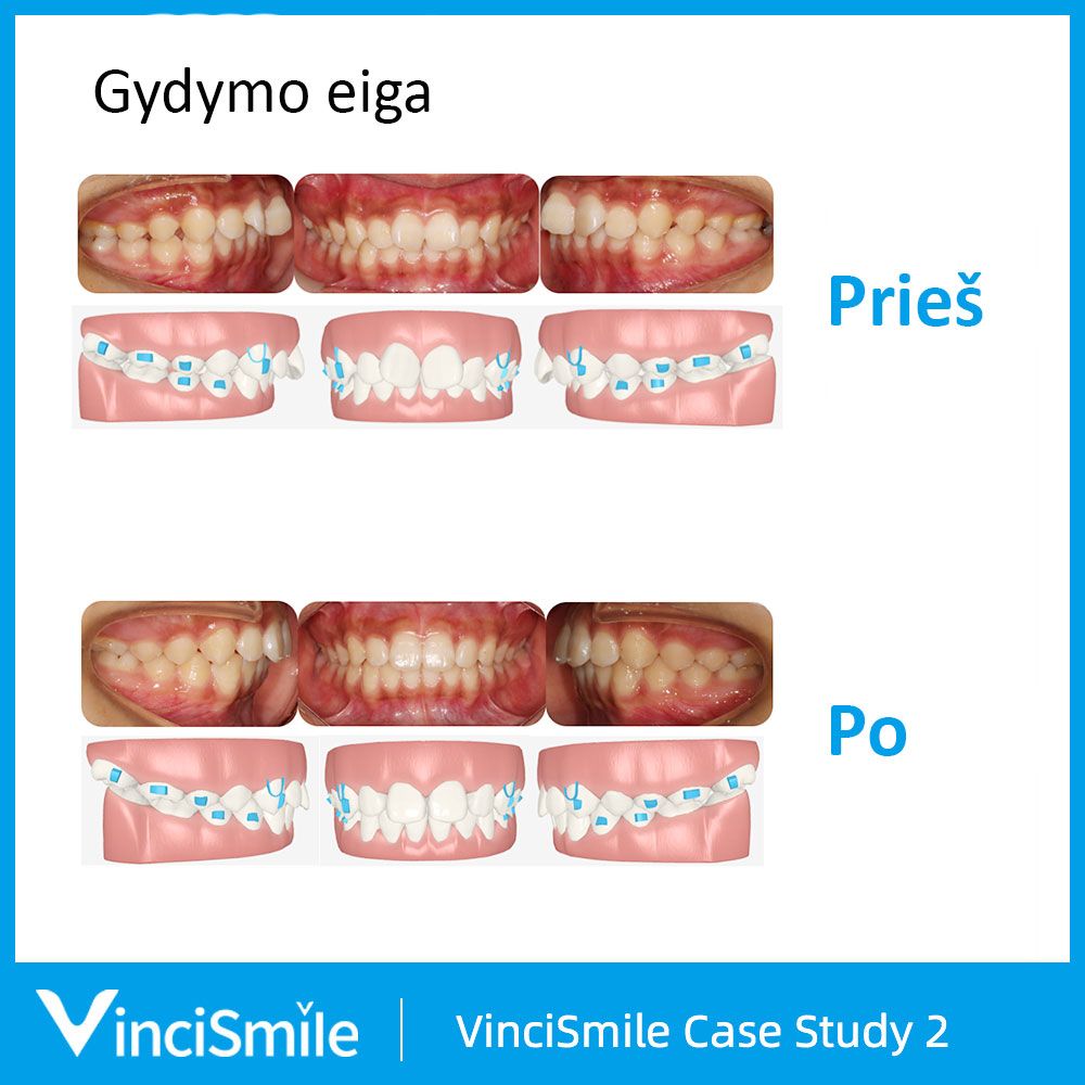 VinciSmile prieš ir po
