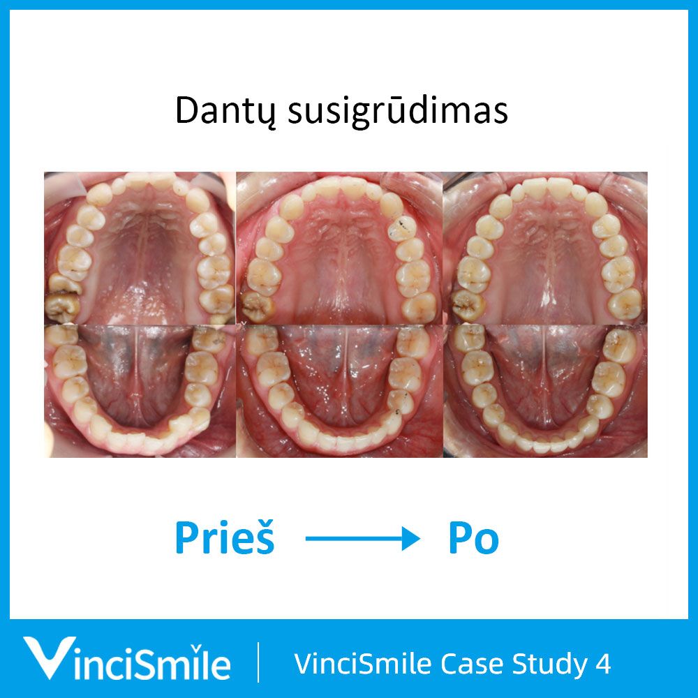 VinciSmile prieš ir po