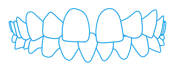 tarpai tarp dantų