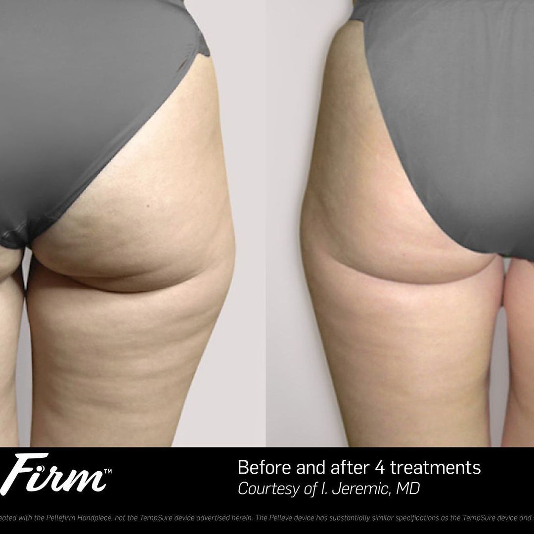 before and after cellulite removal