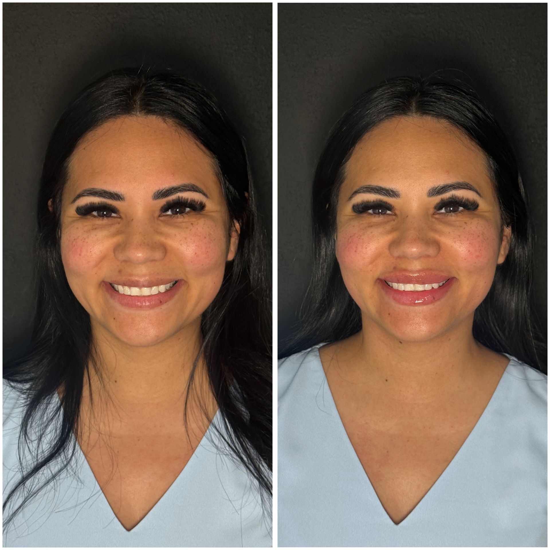 Woman with smiling face, before and after cosmetic procedure. Skin appears smoother and lips fuller in after photo.
