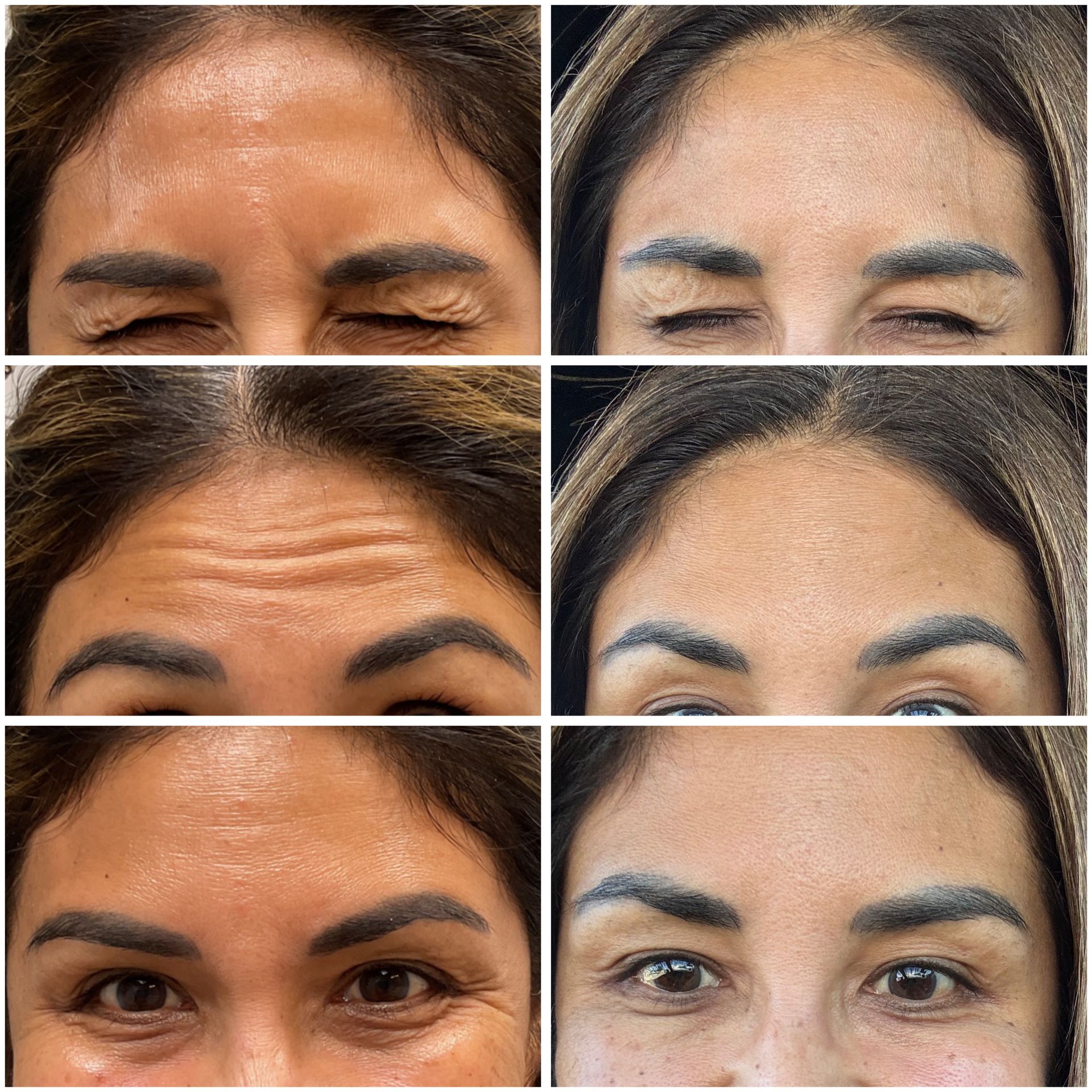 Before and after shots of woman's forehead and eyes, showing reduction in wrinkles from a cosmetic procedure.