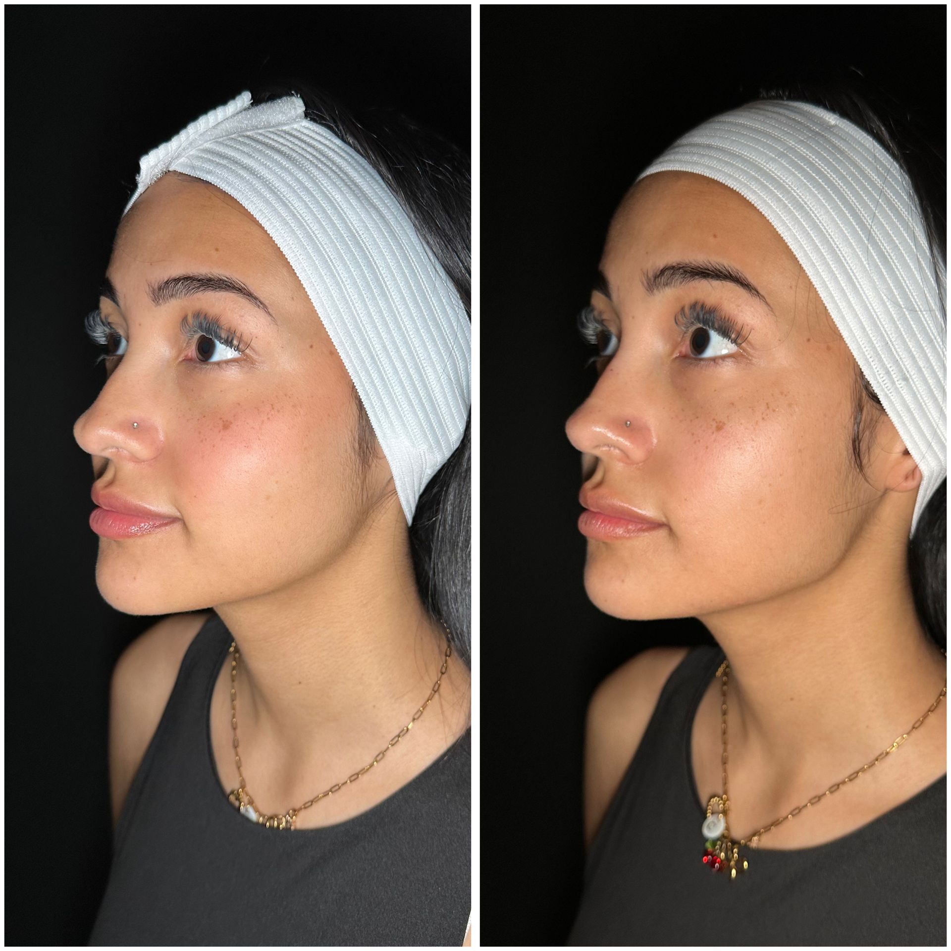 Two side-by-side photos: woman with a nose job, before and after. Dark background, wearing a headband, tank top, and necklace.