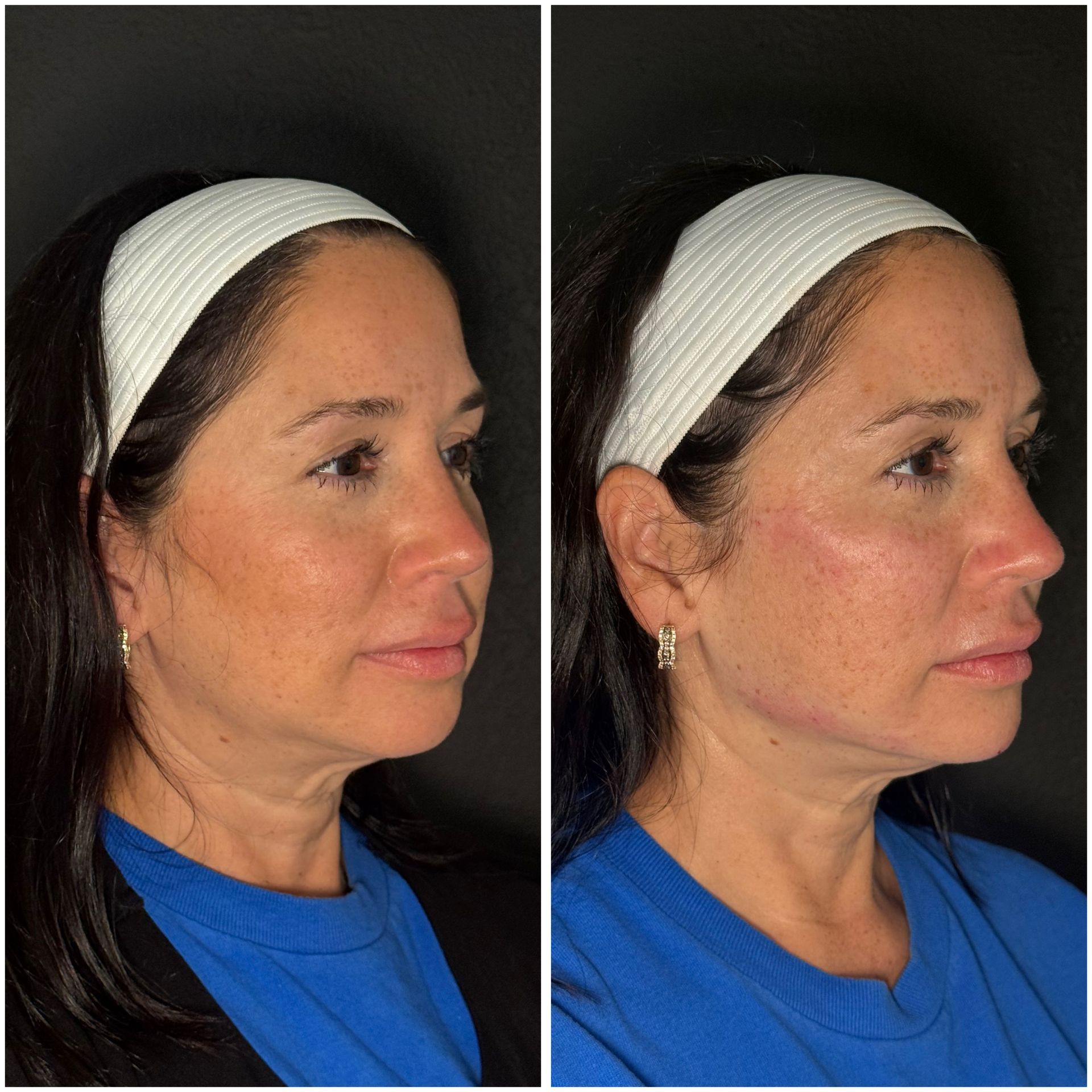Before-and-after showing a woman's face, possibly following cosmetic enhancements.