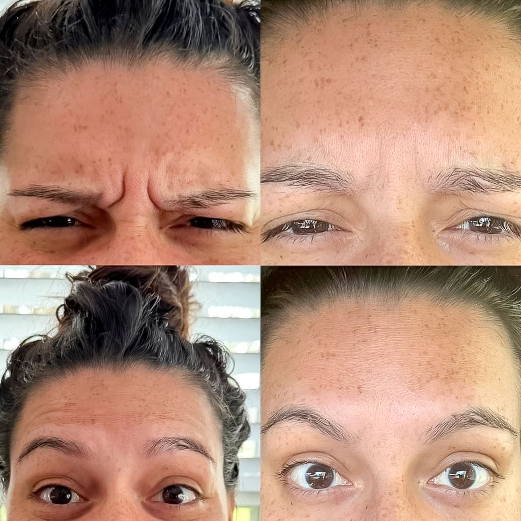 A woman 's forehead is shown before and after botox injections.