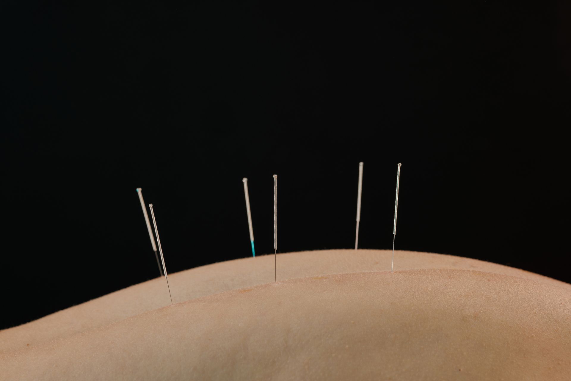 A physiotherapist inserts thin needles into a patient's back during dry needling therapy.