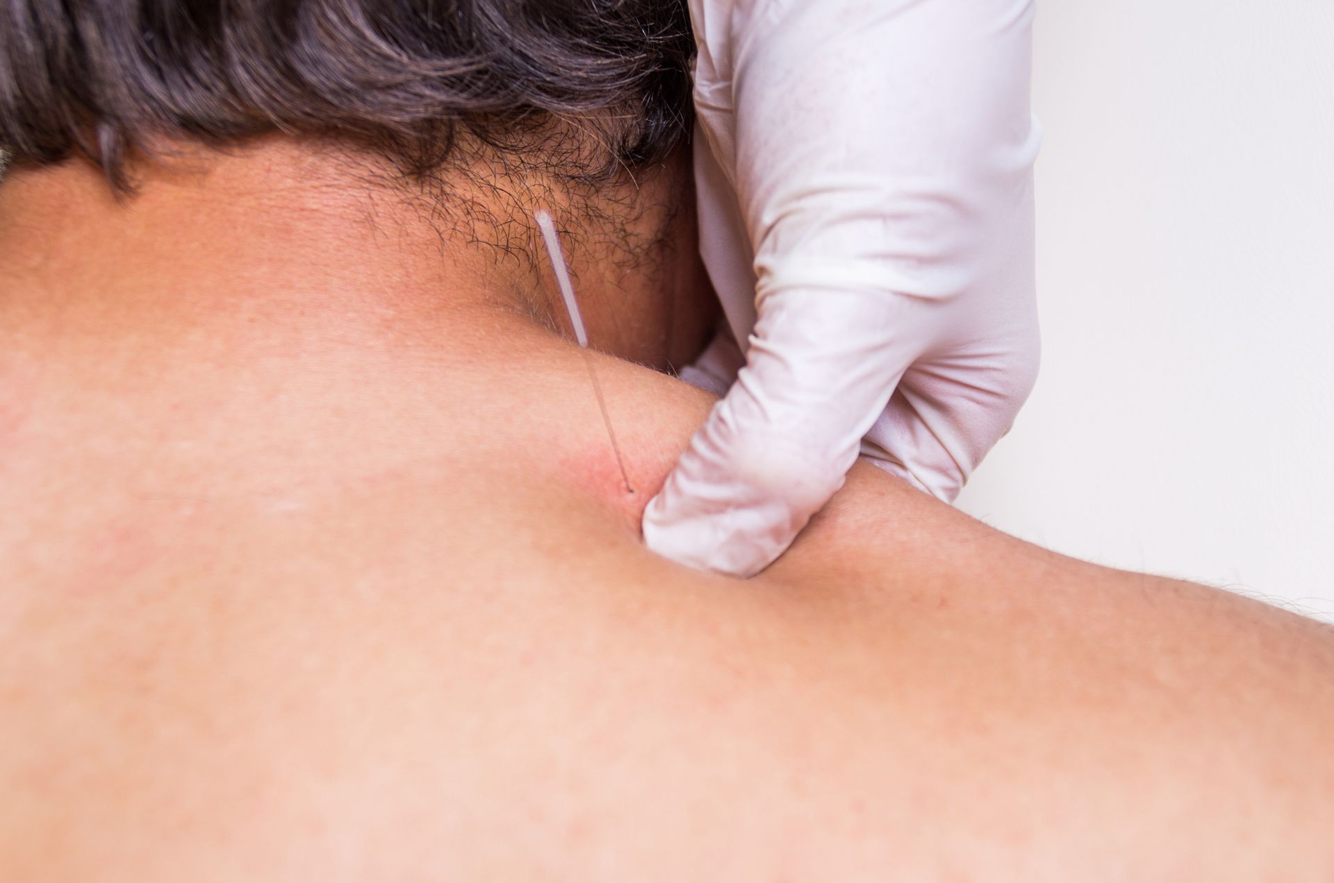 Man’s back with a needle used in dry needling, a gloved hand grabbing the skin.