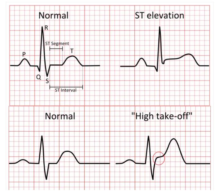 STEMI ECG