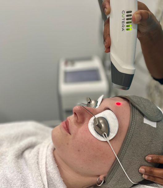 A woman is getting a laser treatment on her face.