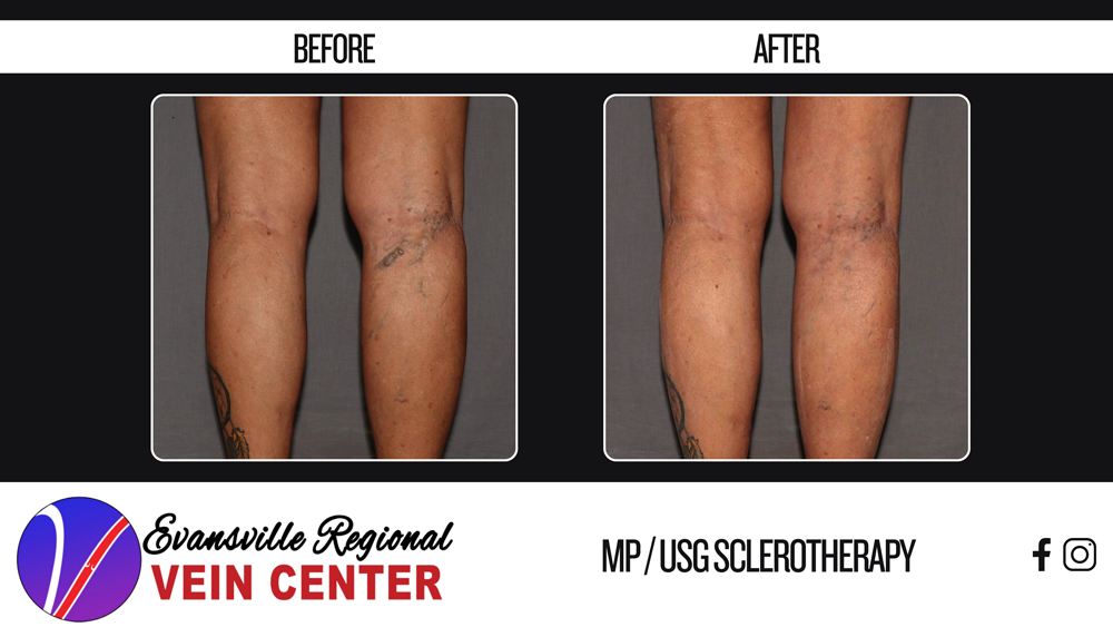 Ultrasound-Guided Sclerotherapy | Evansville Regional Vein Center