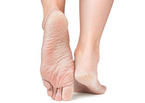 skin diseases on feet