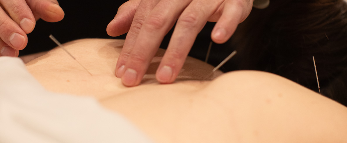 Acupuncture