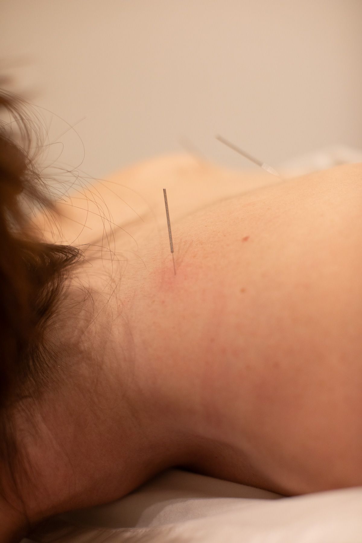 Acupuncture