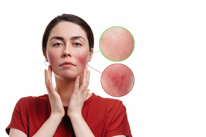 Trattamento cosmetico sul viso di una donna con mani guantate e applicatore di gel.