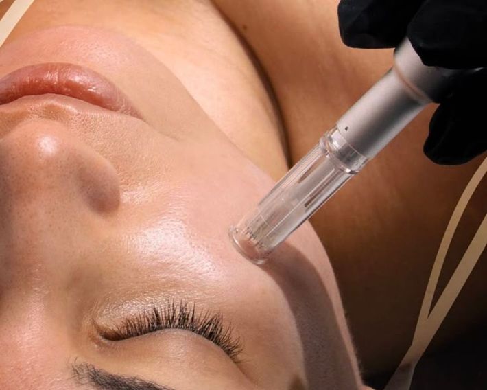 Trattamento cosmetico sul viso di una donna con mani guantate e applicatore di gel.