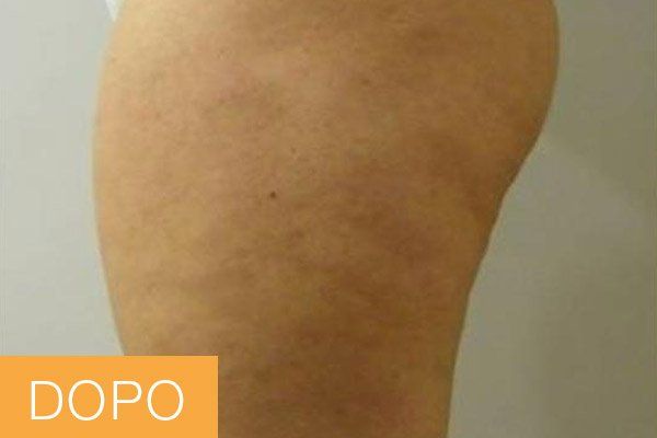 trattamenti corpo - dopo