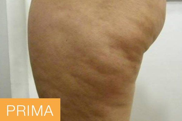 trattamenti corpo - prima