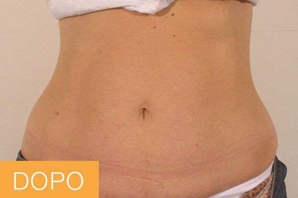 trattamenti corpo - dopo