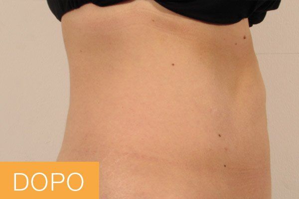 trattamenti corpo - dopo