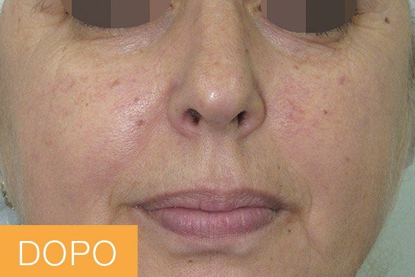 trattamenti viso - dopo