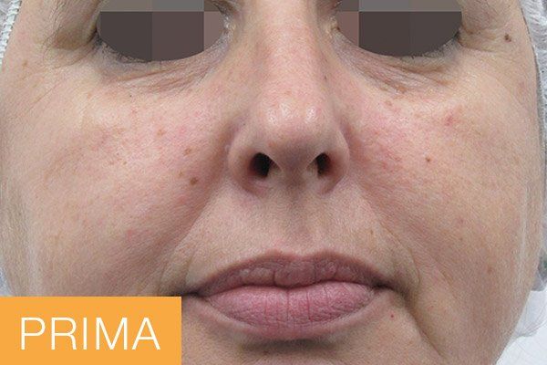 trattamenti viso - prima