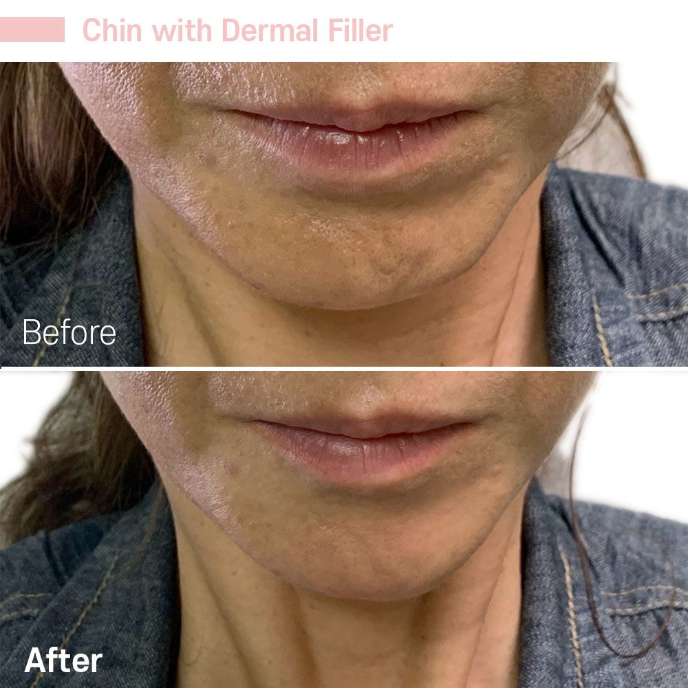 A before and after photo of a woman 's chin with dermal filler.