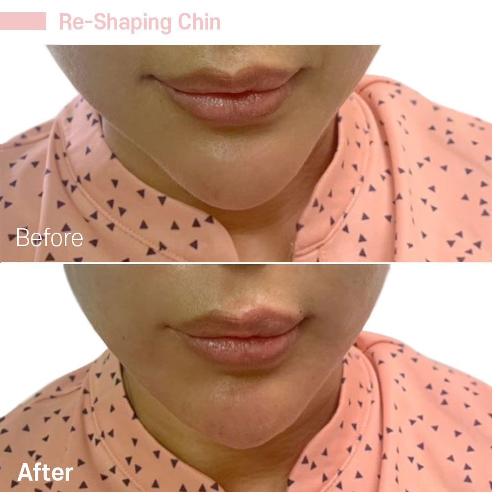 A before and after photo of a woman 's chin