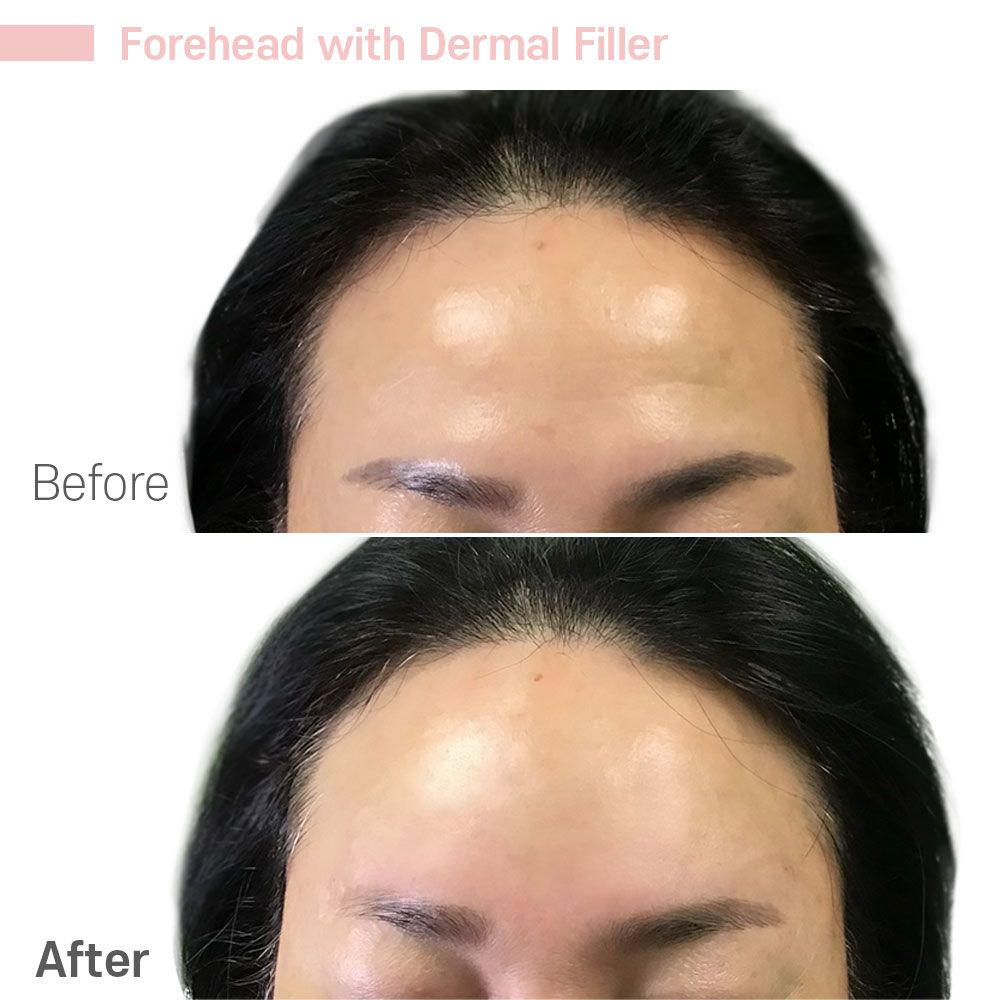 A before and after photo of a woman 's forehead with dermal filler.