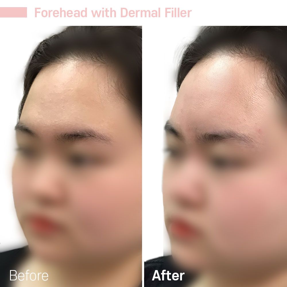 A before and after photo of a woman 's forehead with dermal filler.