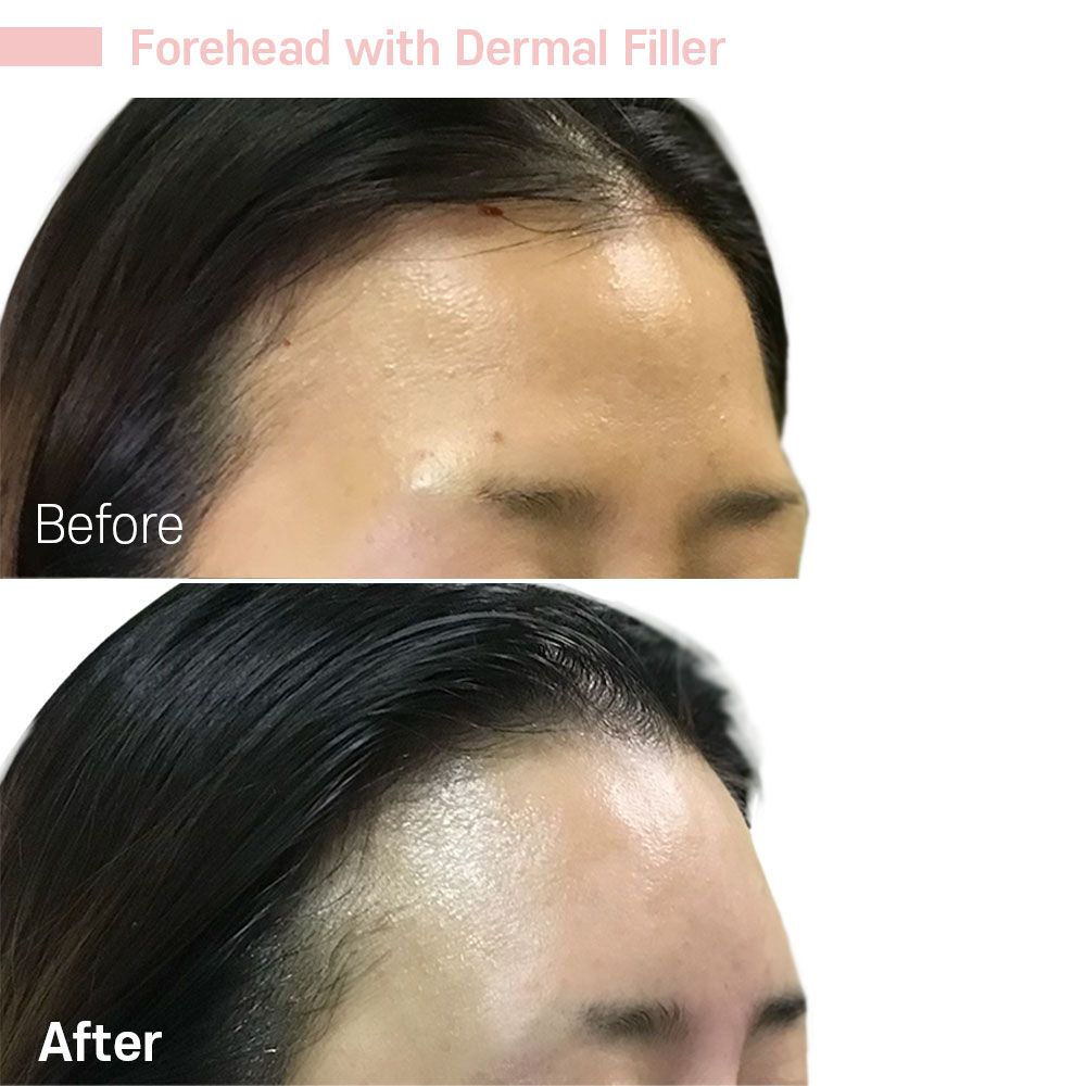 A before and after photo of a woman 's forehead with dermal filler.