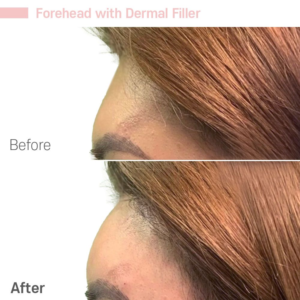 A before and after photo of a woman 's forehead with dermal filler.