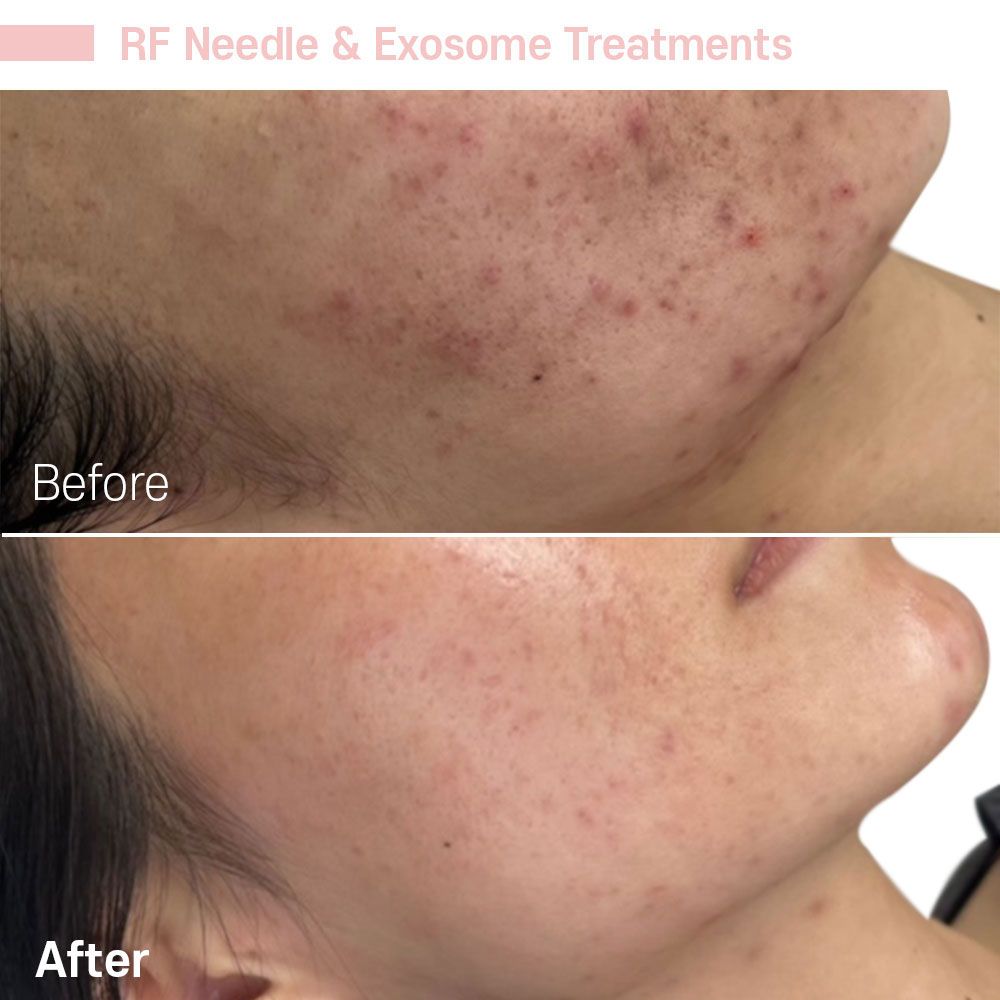 A woman 's face before and after rf needle and exosome treatments.