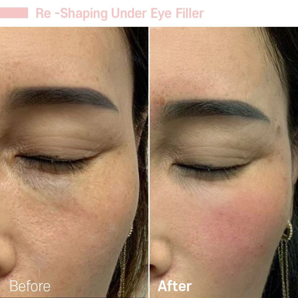 A before and after photo of a woman 's face with eye filler.