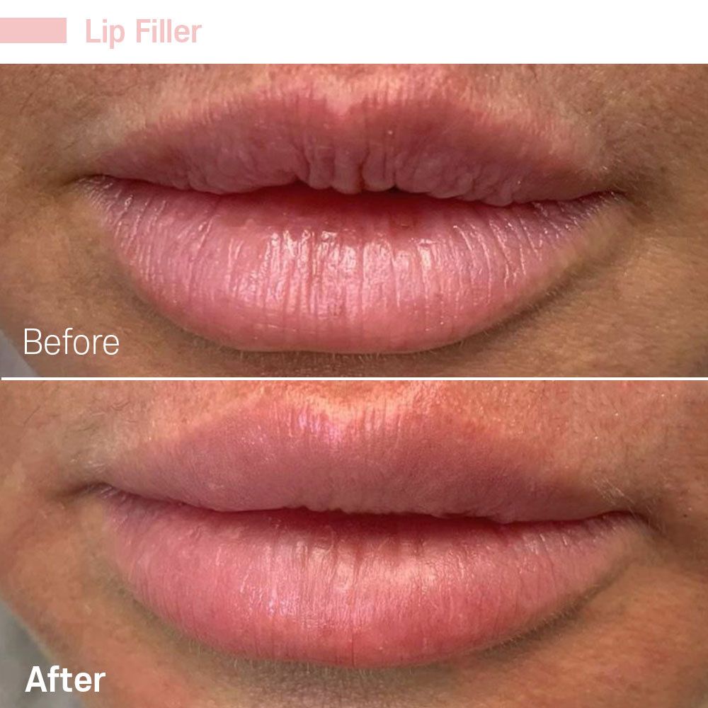 A before and after photo of a woman 's lips with lip filler.